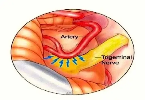 conflito neurovascular