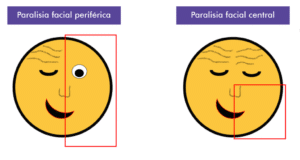 Paralisia facial