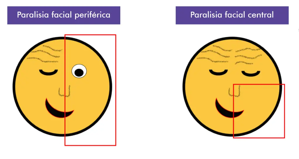 paralisia facial