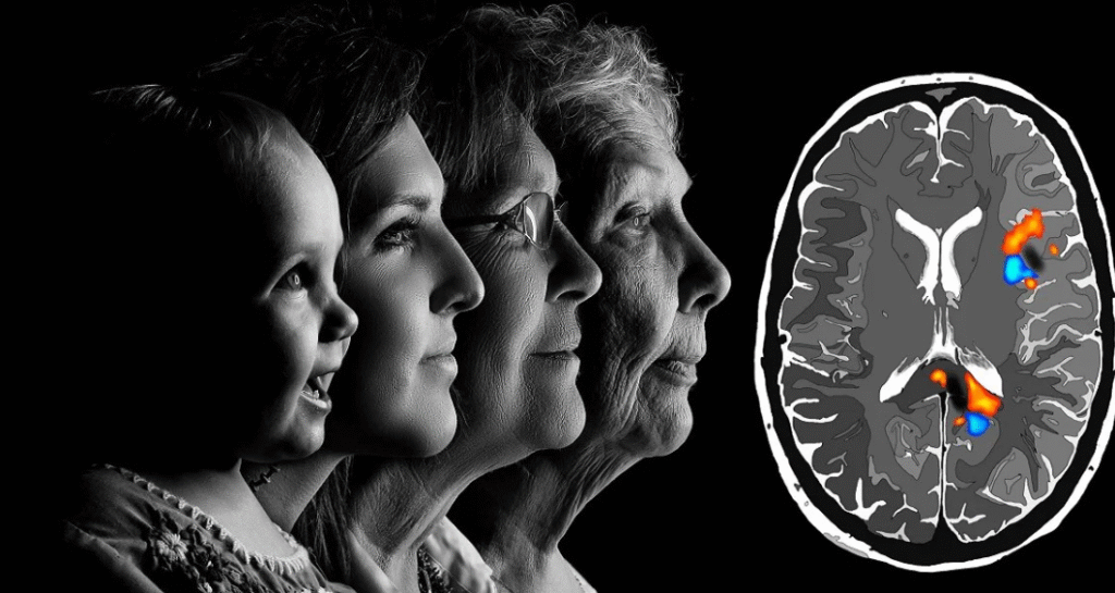 Alzheimer