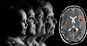 Alzheimer